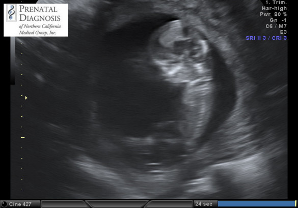 Ultrasound 8-25-15