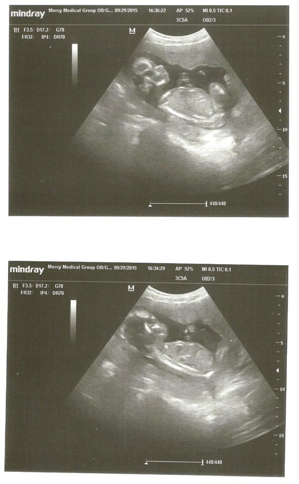 Ultrasound 9-29-15