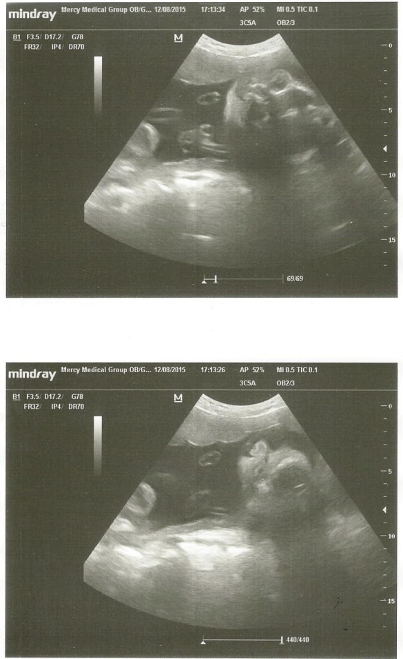 Ultrasound 12-8-15. Tilt your head slightly to the right and you can see baby C's face. 