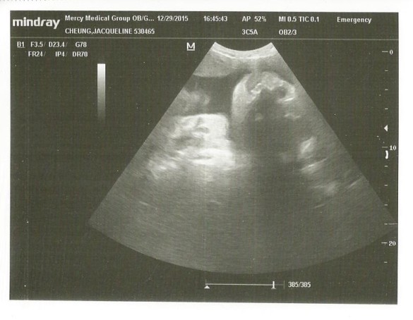 Ultrasound 12-29-15
