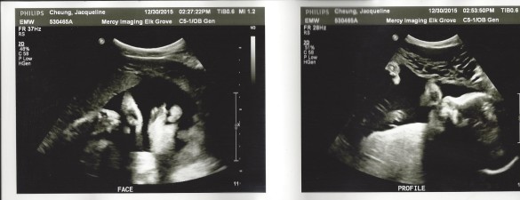 Ultrasound 12-30-15